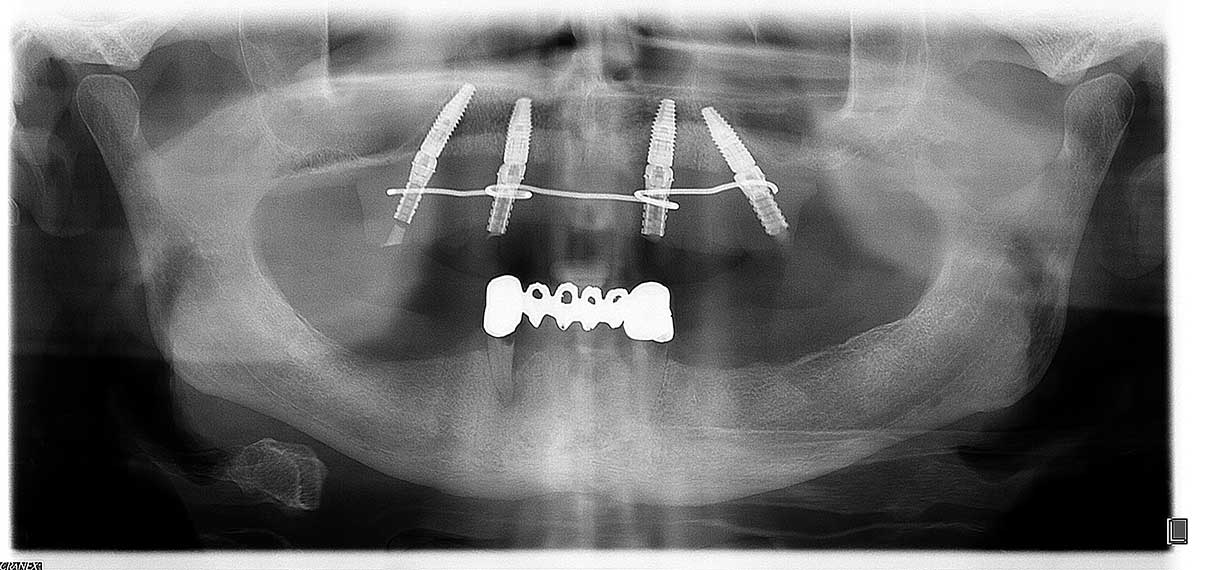 Ortopan All on 4 Dentalna Ordinacija Goljak