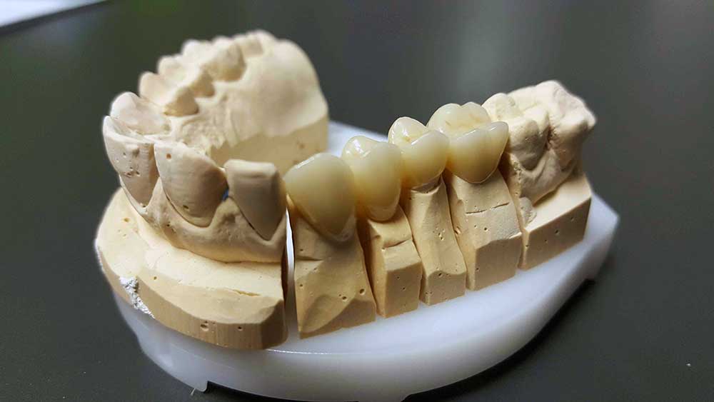 Total ceramic dental crowns on model Dentalna Ordinacija Goljak