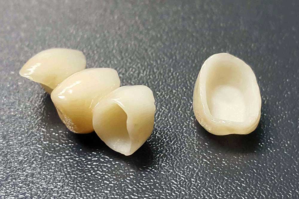 Total ceramic dental crowns Dentalna Ordinacija Goljak